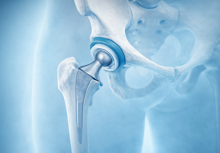 Ολική αρθροπλαστική ισχίου: Πότε χρειάζεται και τι να περιμένετε